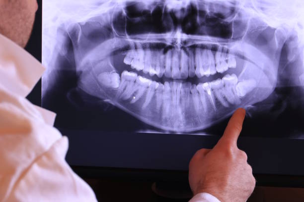 Best Emergency Wisdom Teeth Removal in Thompsons Station, TN